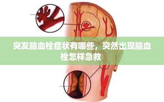 突发脑血栓症状有哪些，突然出现脑血栓怎样急救 