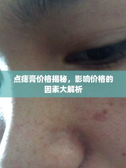 点痣膏价格揭秘，影响价格的因素大解析